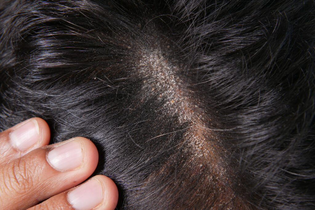 Can Dandruff Affect Hair Growth? Myths vs. Facts! Featured Image 114569332